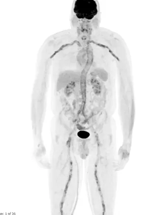 הדמיית PET-CT של הגוף המלא, המשמשת להערכת דלקת בכלי דם במהלך בירור וסקוליטיס